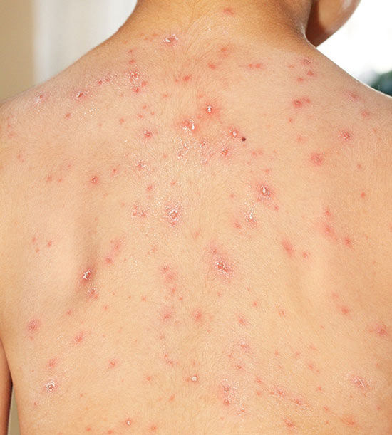 natural-remedies-for-the-chicken-pox-alternative-resources-directory