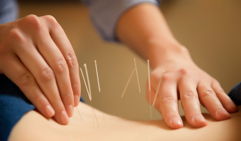 acupuncture for all those aches and pains